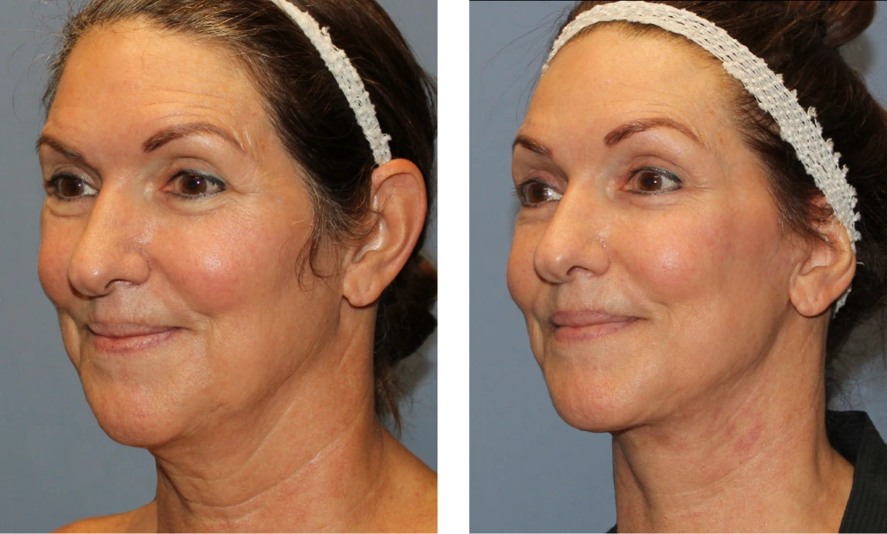 Brow Lift - Case 4 (3)