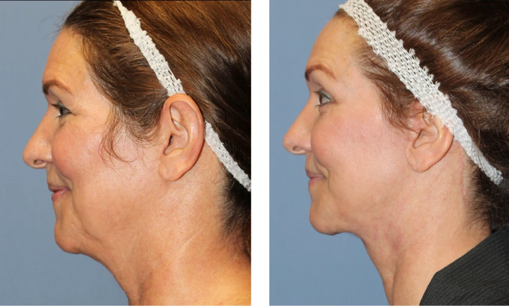 Brow Lift - Case 4 (4)