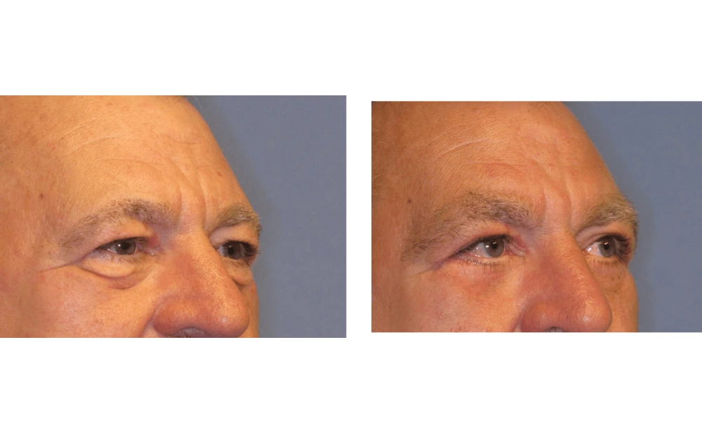 Eyelid Surgery (Blepharoplasty) - Case 1 (1)