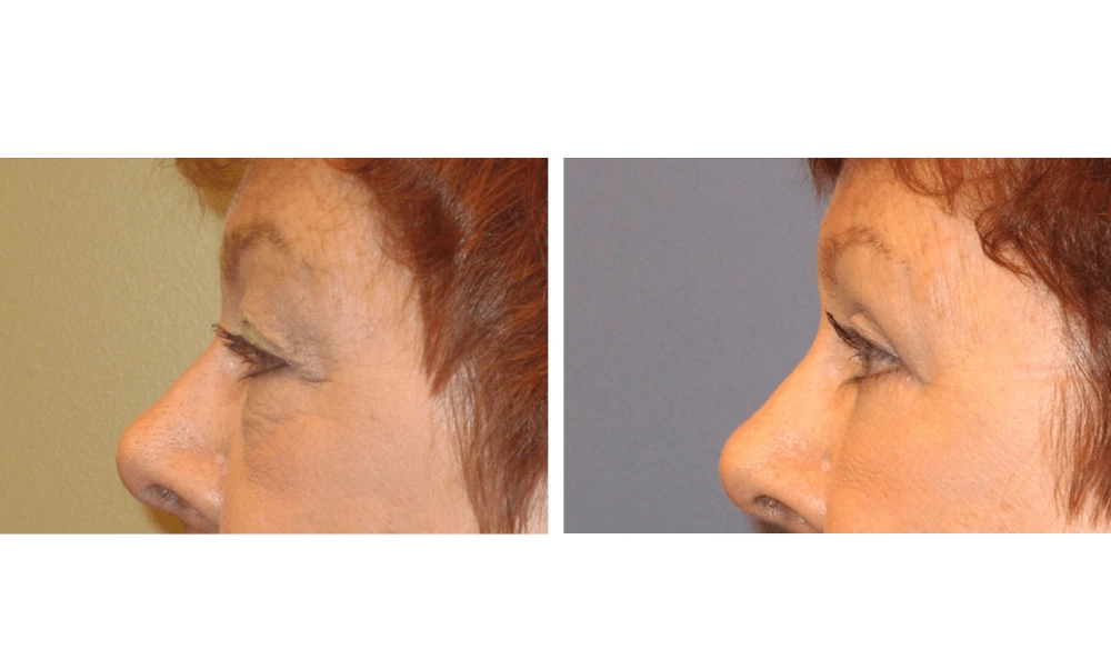 Eyelid Surgery (Blepharoplasty) - Case 1 (10)