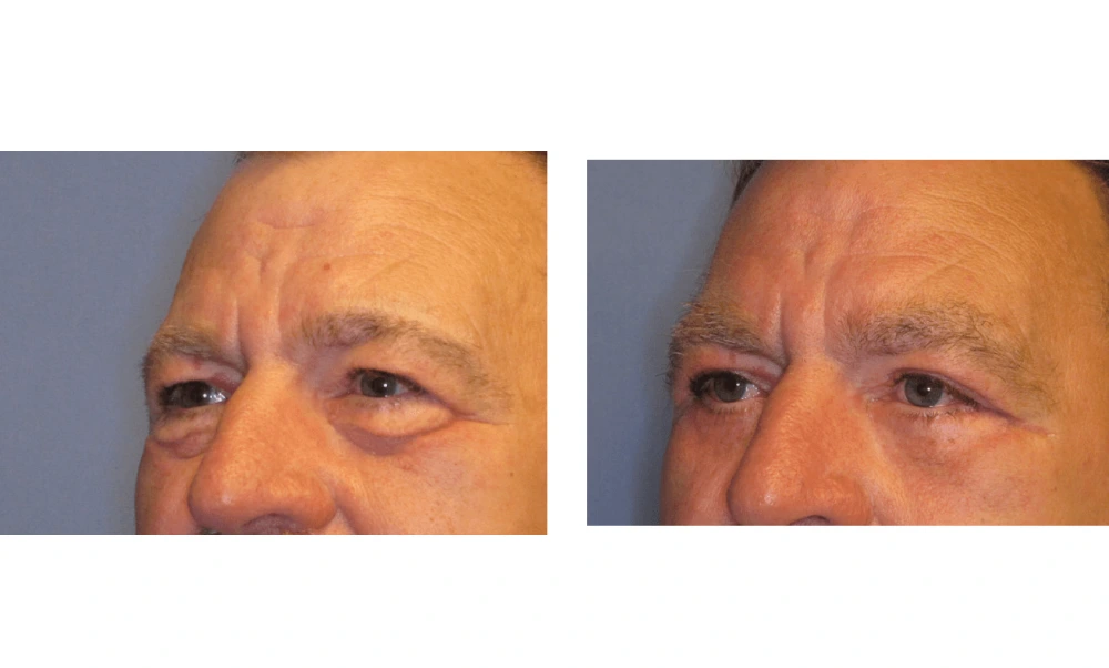 Eyelid Surgery (Blepharoplasty) - Case 1 (3)