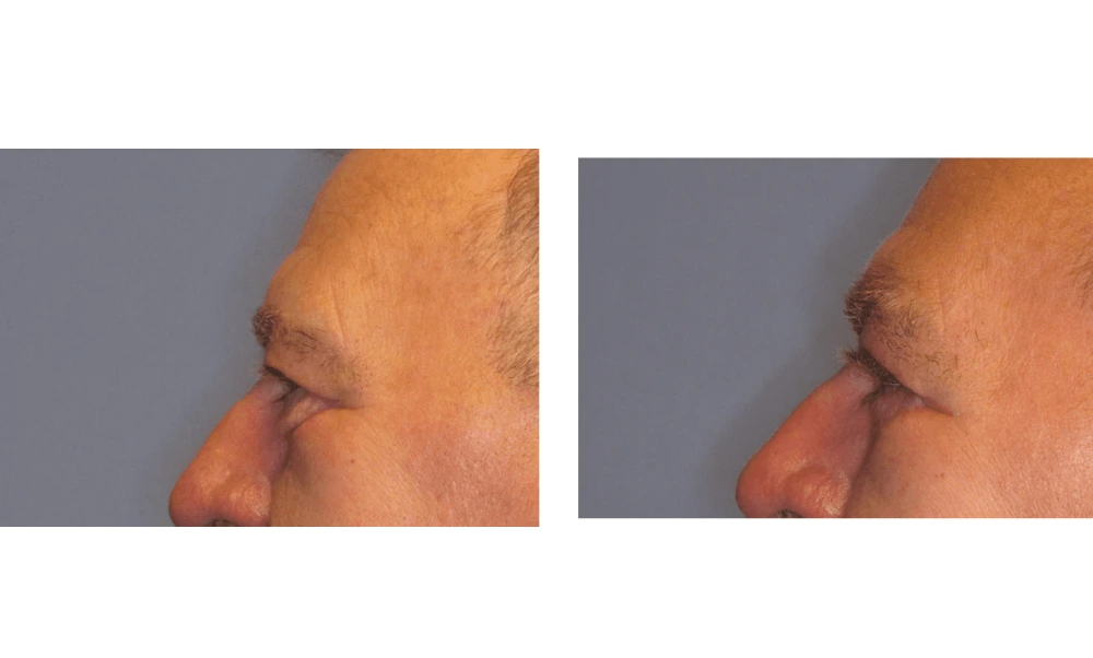Eyelid Surgery (Blepharoplasty) - Case 1 (4)