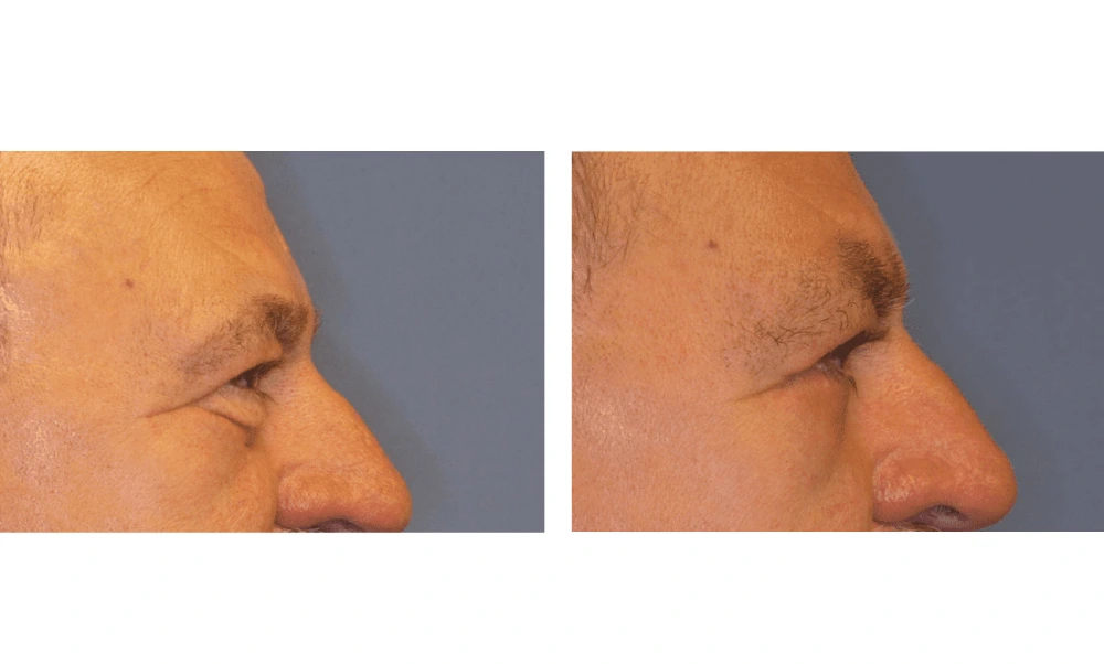 Eyelid Surgery (Blepharoplasty) - Case 1 (5)