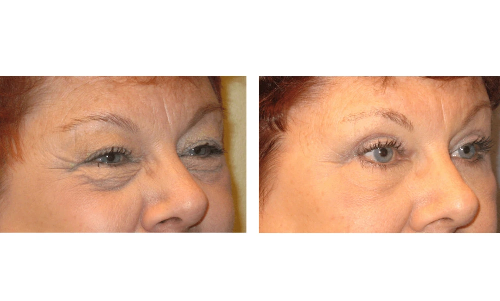 Eyelid Surgery (Blepharoplasty) - Case 1 (7)