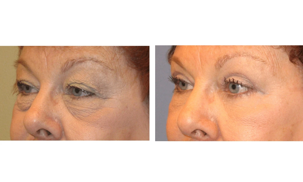 Eyelid Surgery (Blepharoplasty) - Case 1 (9)