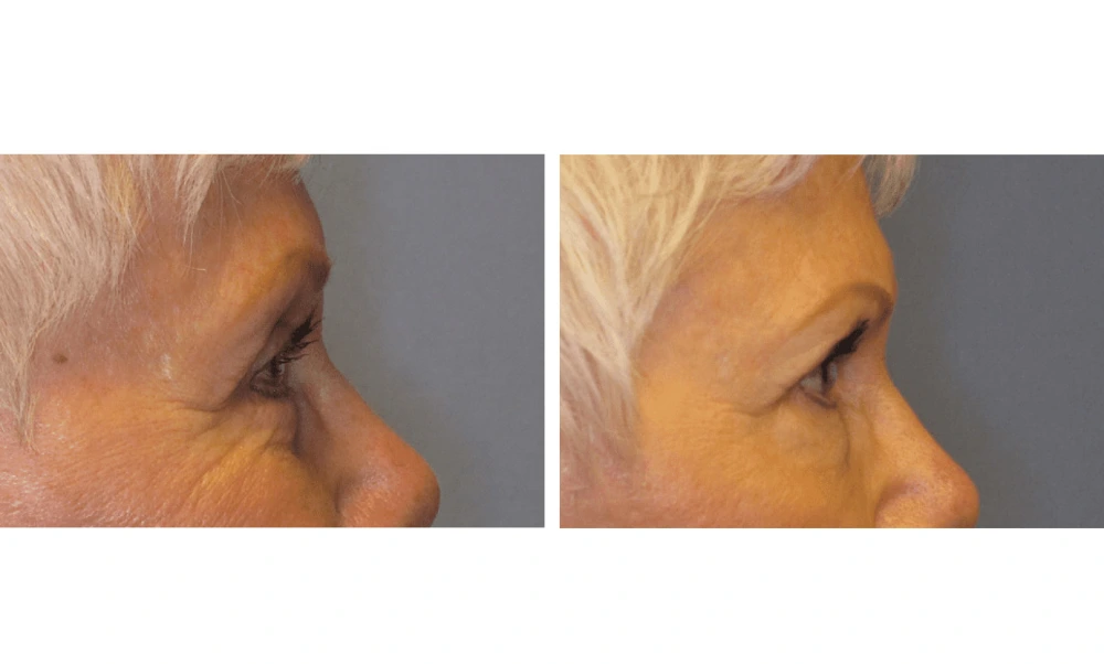 Eyelid Surgery (Blepharoplasty) - Case 3 (1)