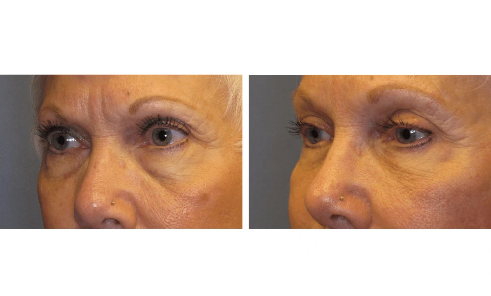 Eyelid Surgery (Blepharoplasty) - Case 3 (2)