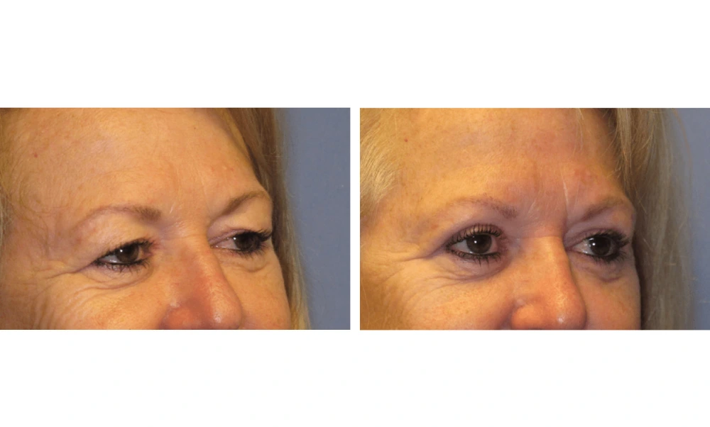Eyelid Surgery (Blepharoplasty) - Case 4 (1)