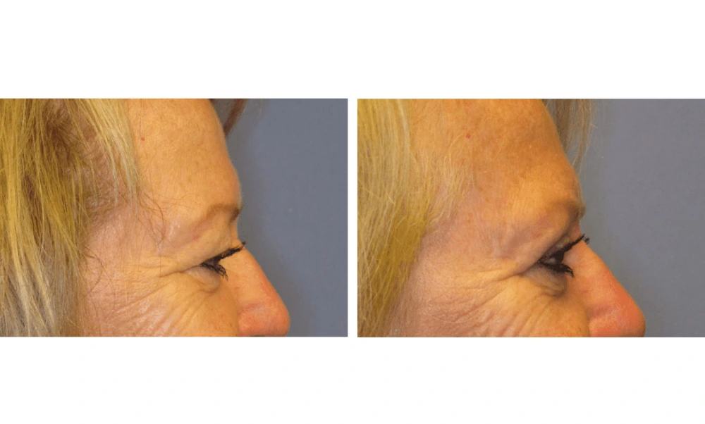 Eyelid Surgery (Blepharoplasty) - Case 4 (3)