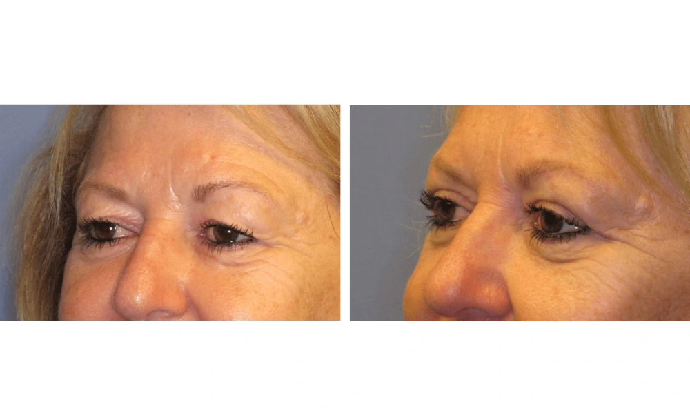 Eyelid Surgery (Blepharoplasty) - Case 4 (4)