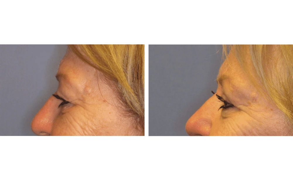 Eyelid Surgery (Blepharoplasty) - Case 4 (5)