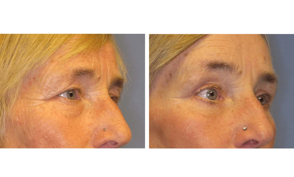 Eyelid Surgery (Blepharoplasty) - Case 5 (1)