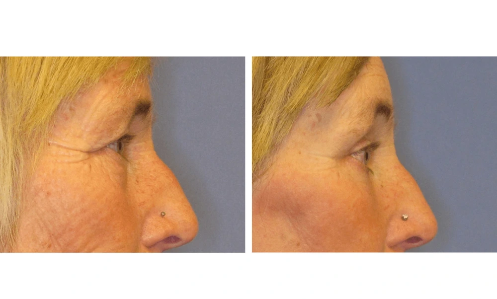 Eyelid Surgery (Blepharoplasty) - Case 5 (2)