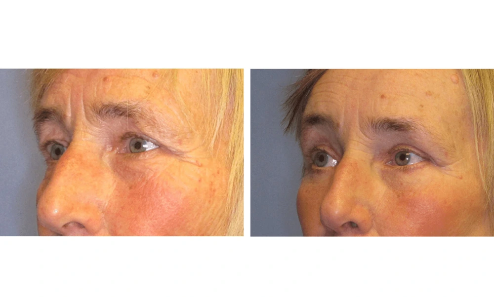 Eyelid Surgery (Blepharoplasty) - Case 5 (3)