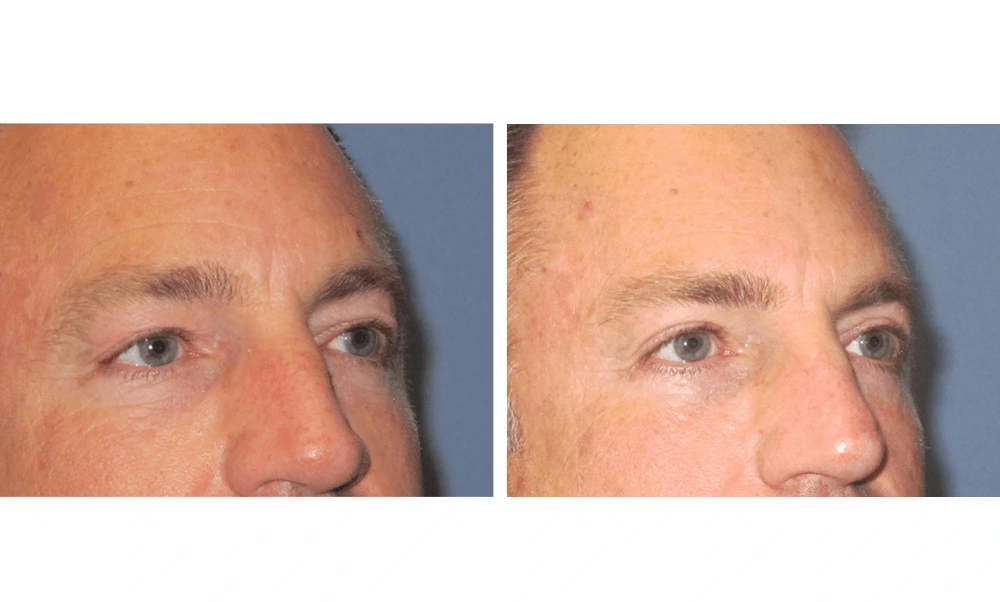 Eyelid Surgery (Blepharoplasty) - Case 6 (1)