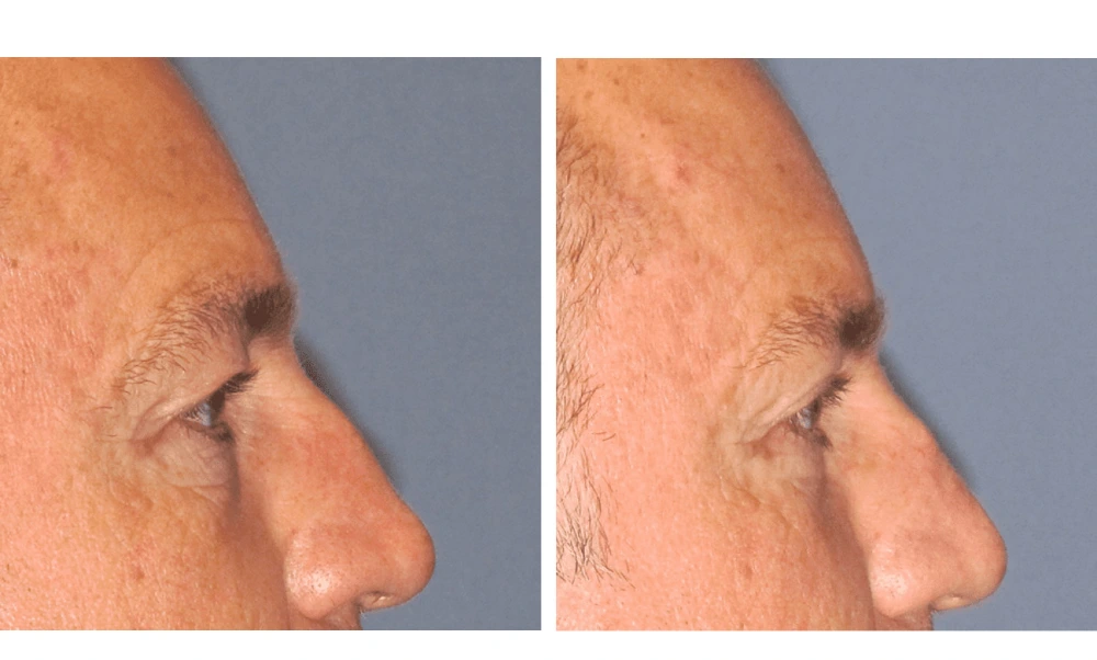 Eyelid Surgery (Blepharoplasty) - Case 6 (2)