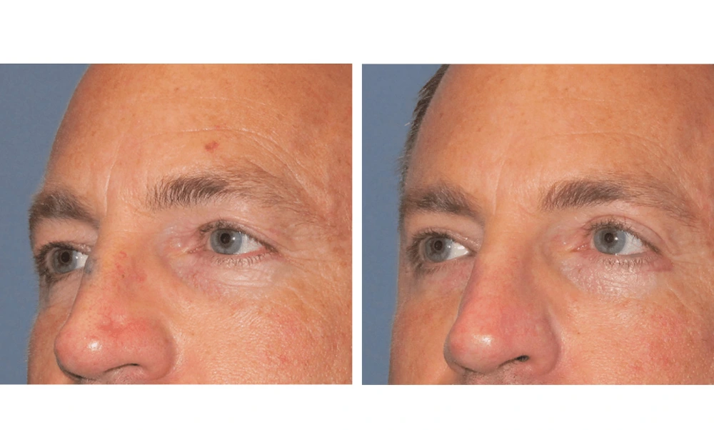 Eyelid Surgery (Blepharoplasty) - Case 6 (3)