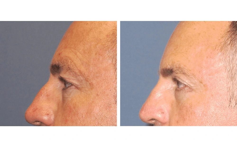 Eyelid Surgery (Blepharoplasty) - Case 6 (4)