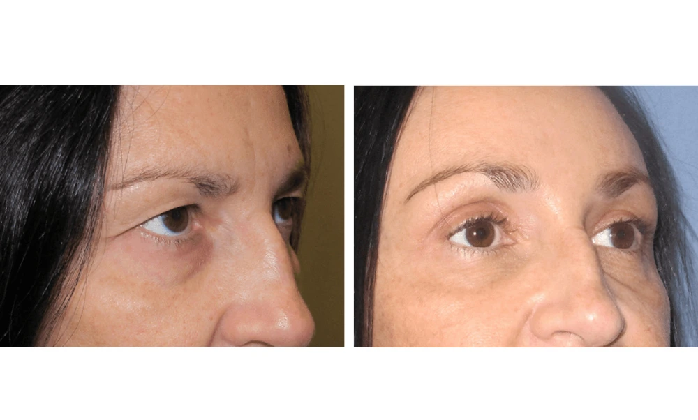 Eyelid Surgery (Blepharoplasty) - Case 7 (1)