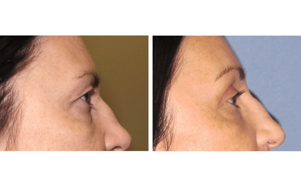 Eyelid Surgery (Blepharoplasty) - Case 7 (2)