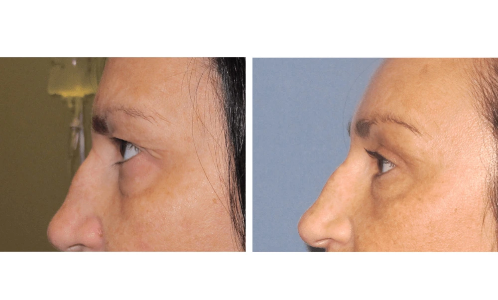 Eyelid Surgery (Blepharoplasty) - Case 7 (4)