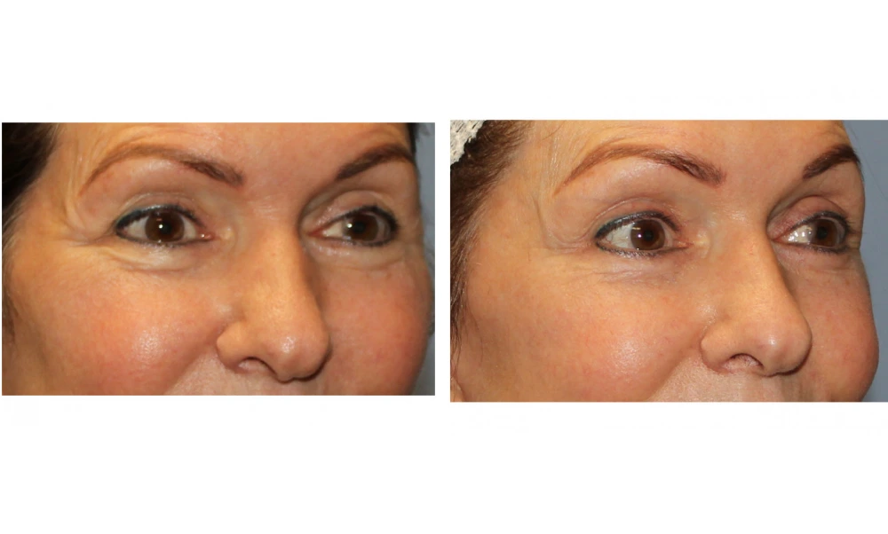 Eyelid Surgery (Blepharoplasty) - Case 8 (1)