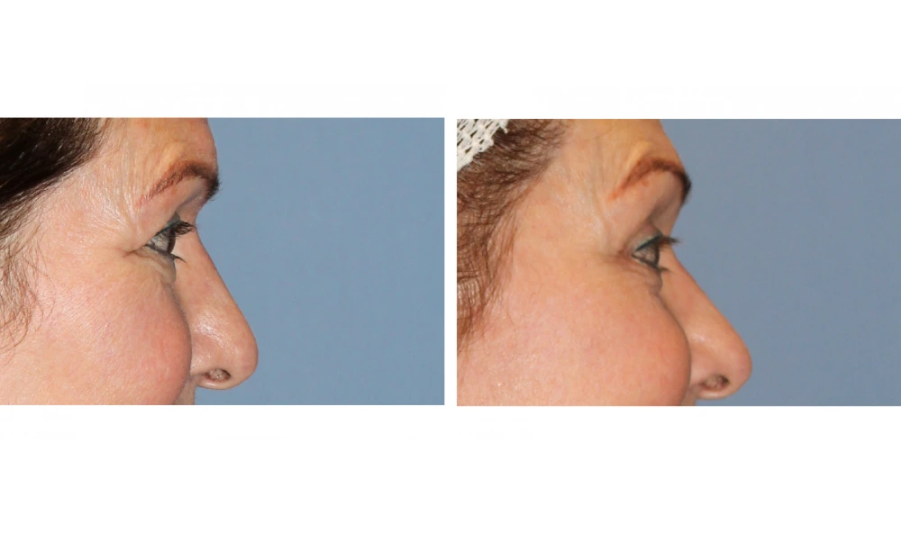 Eyelid Surgery (Blepharoplasty) - Case 8 (2)