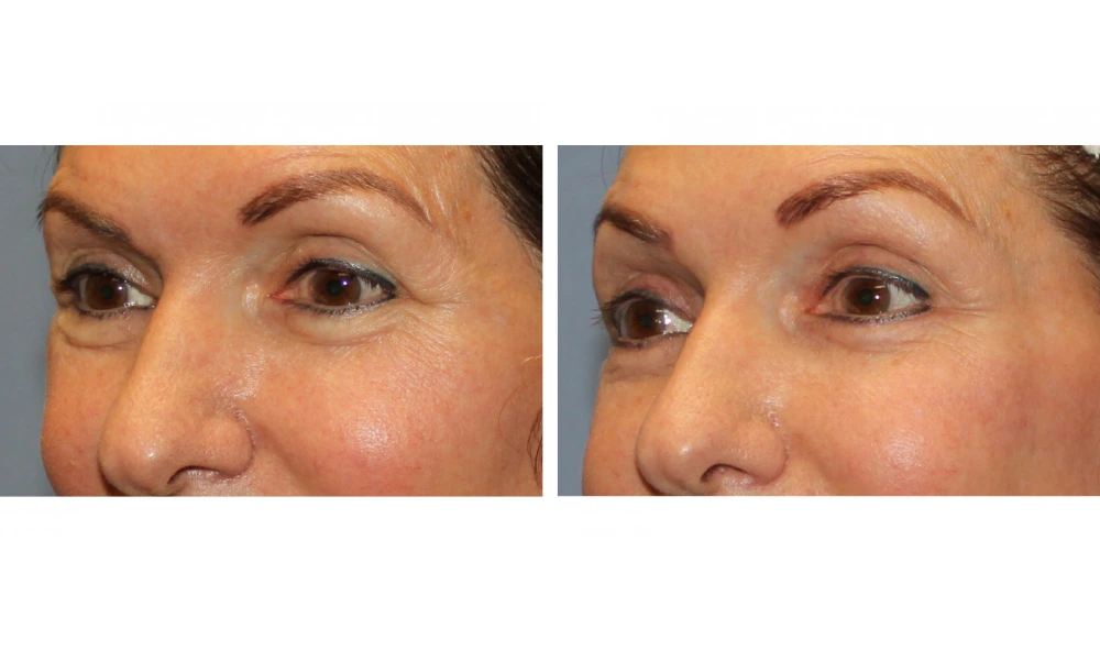 Eyelid Surgery (Blepharoplasty) - Case 8 (3)