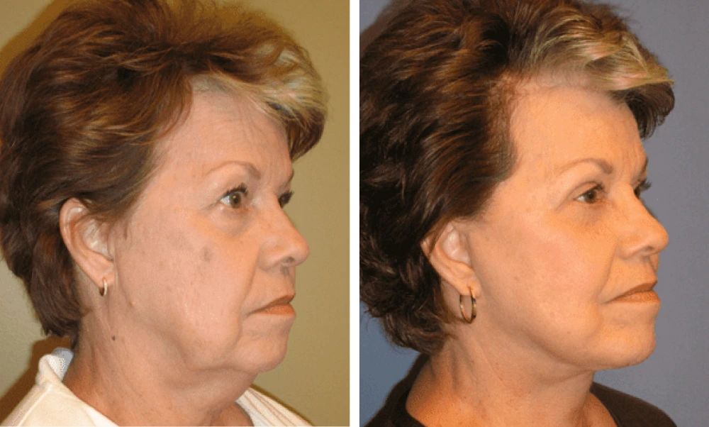 Face Lift - Case 1 (1)