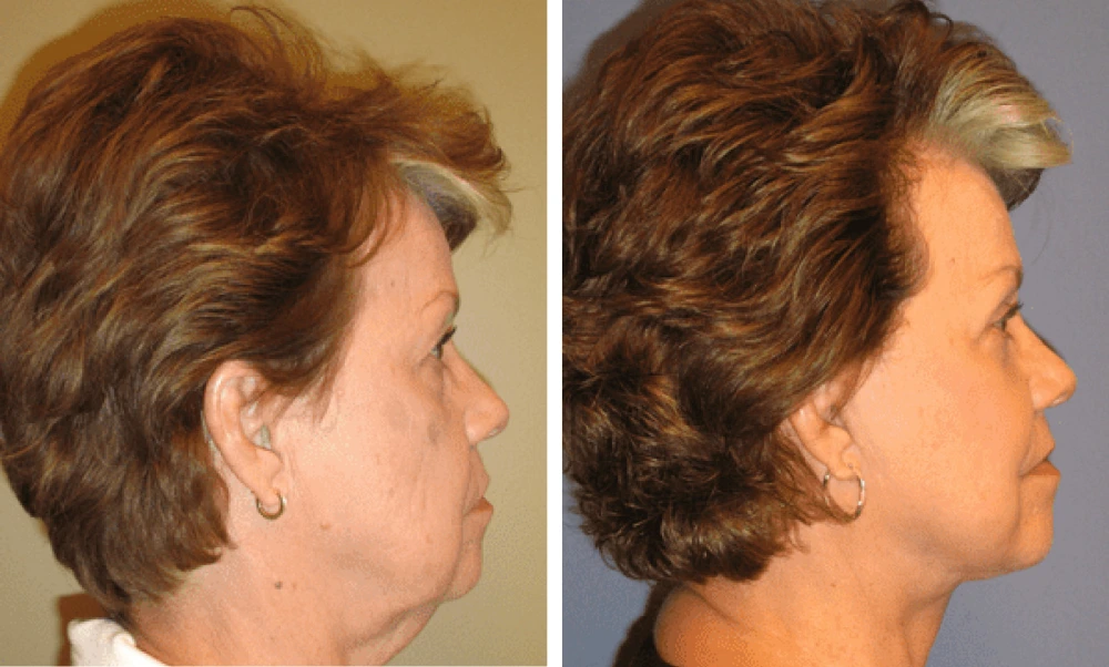 Face Lift - Case 1 (2)