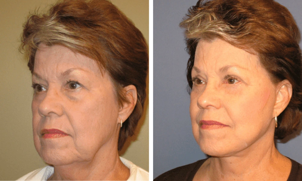 Face Lift - Case 1 (3)