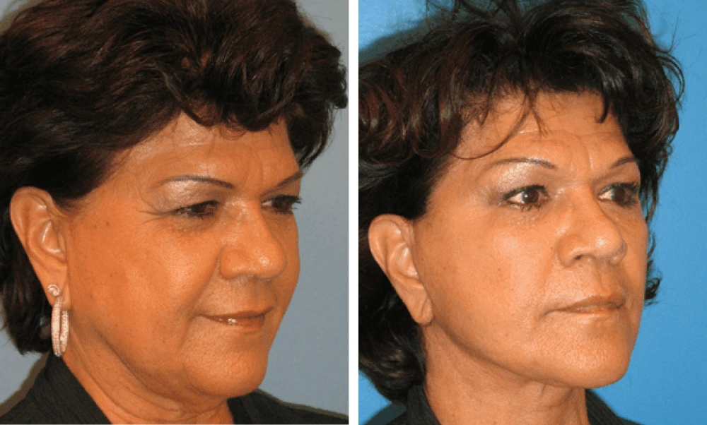 Face Lift - Case 2 (1)