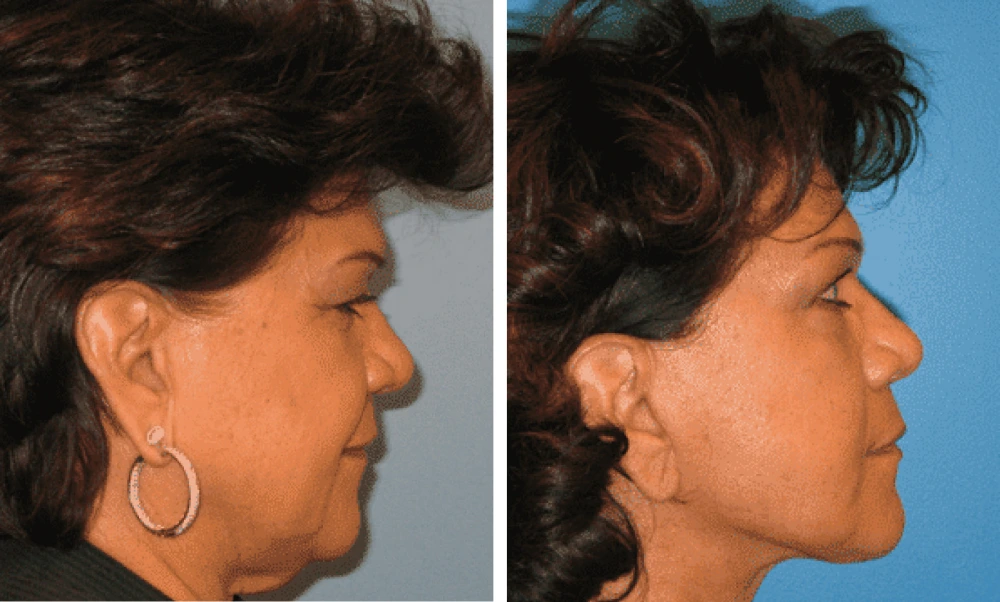 Face Lift - Case 2 (2)