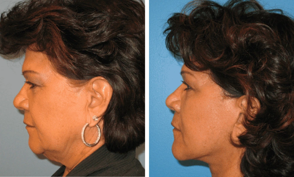 Face Lift - Case 2 (4)