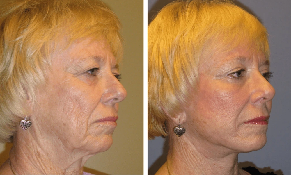 Face Lift - Case 2 (6)