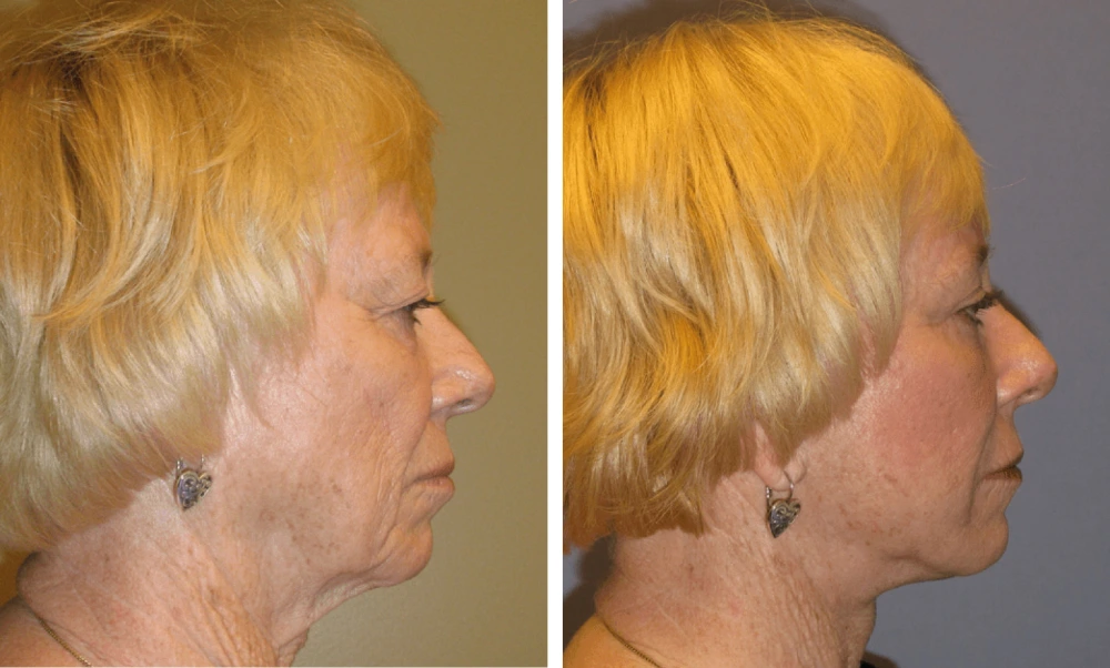 Face Lift - Case 2 (7)