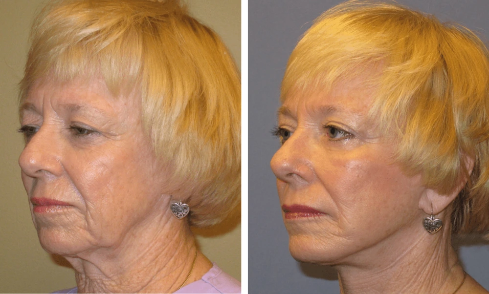 Face Lift - Case 2 (8)