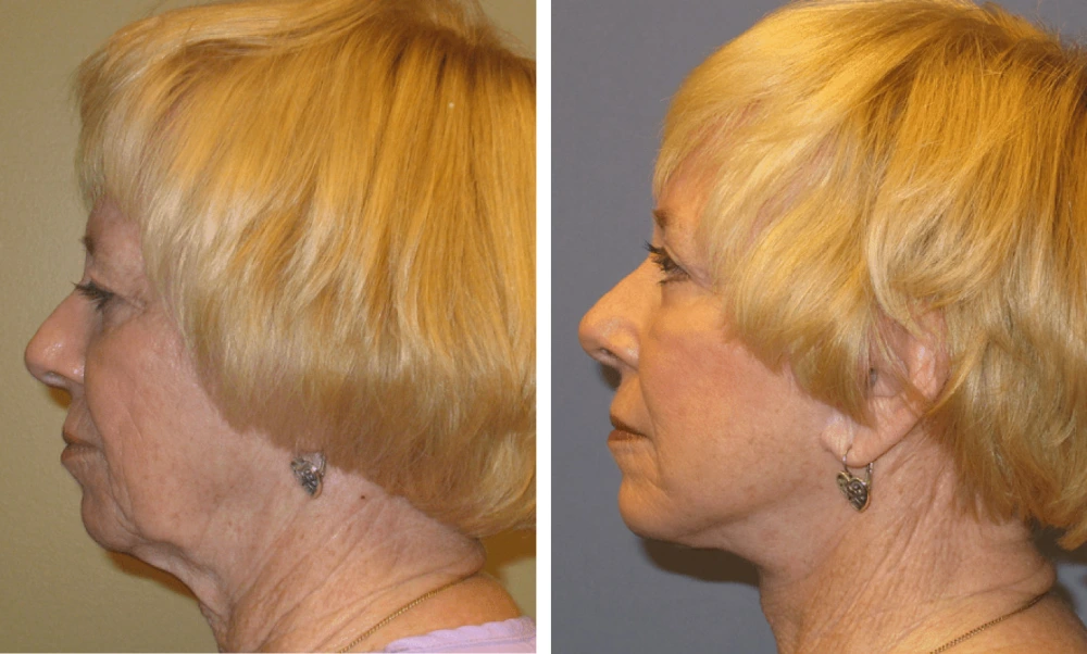 Face Lift - Case 2 (9)