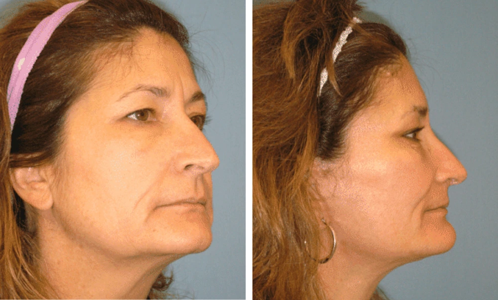 Face Lift - Case 4 (1)