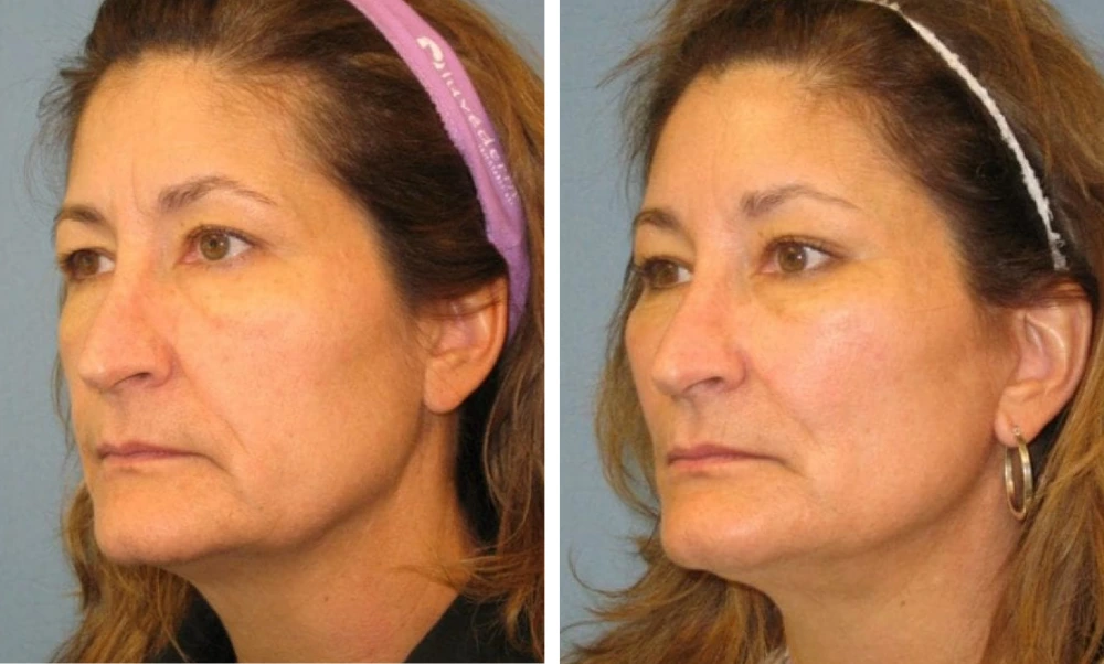 Face Lift - Case 4 (2)