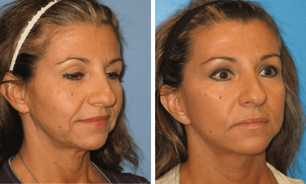 Face Lift - Case 5 (1)