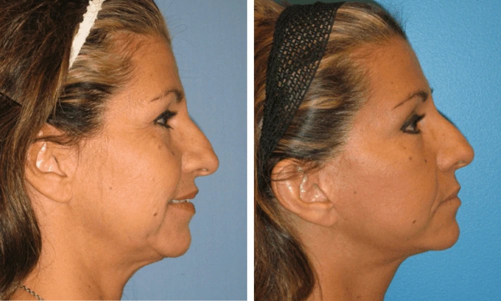 Face Lift - Case 5 (2)