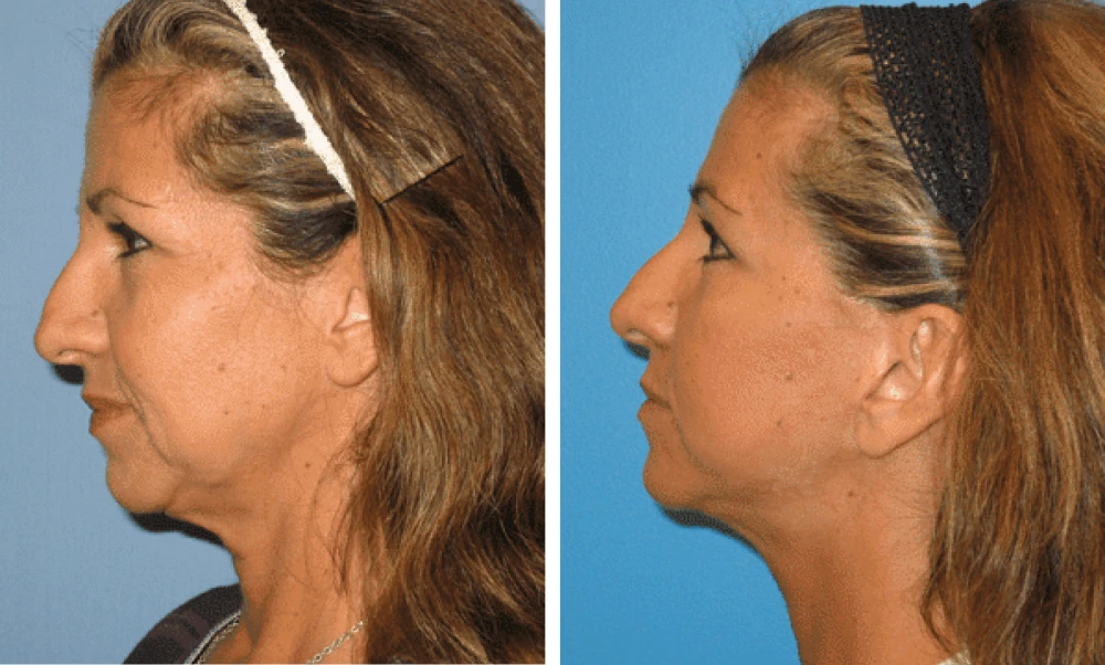 Face Lift - Case 5 (4)