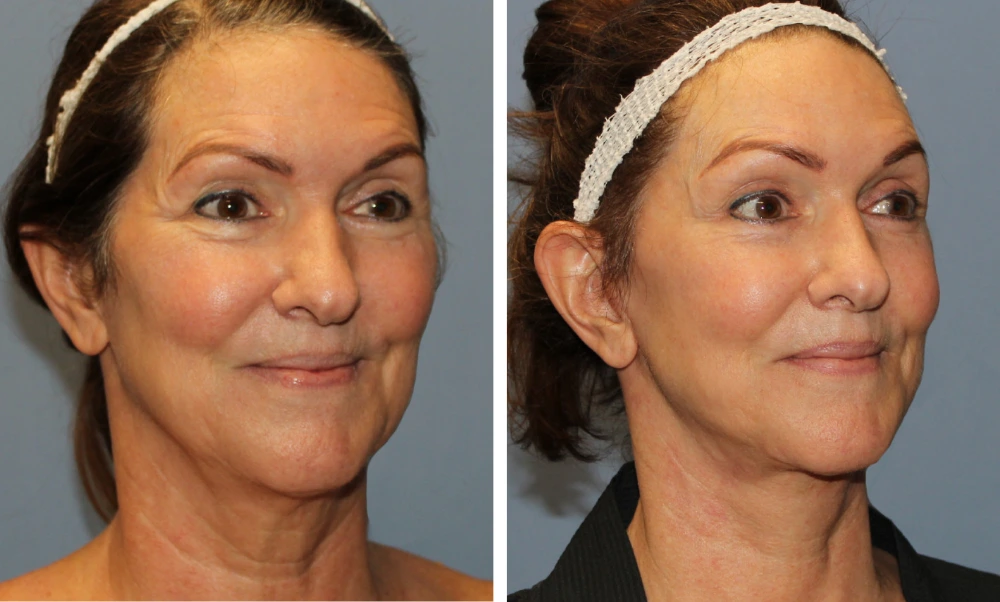 Face Lift - Case 6 (1)