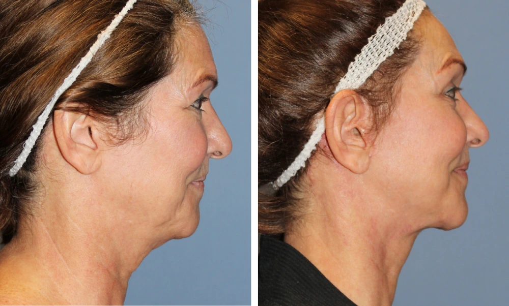 Face Lift - Case 6 (2)