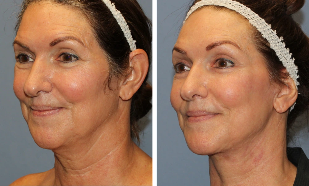 Face Lift - Case 6 (3)