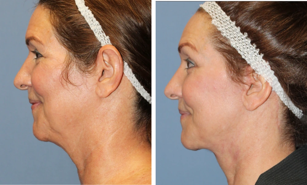 Face Lift - Case 6 (4)