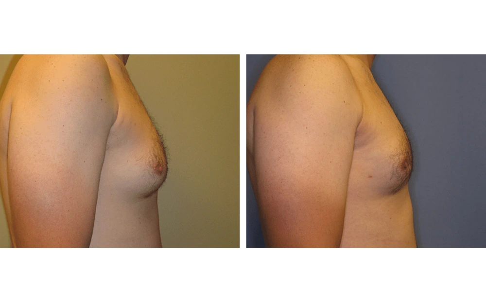 Gynecomastia - Case 1 (2)
