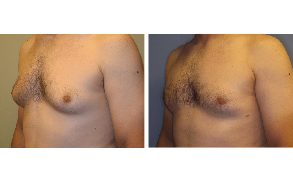 Gynecomastia - Case 1 (3)