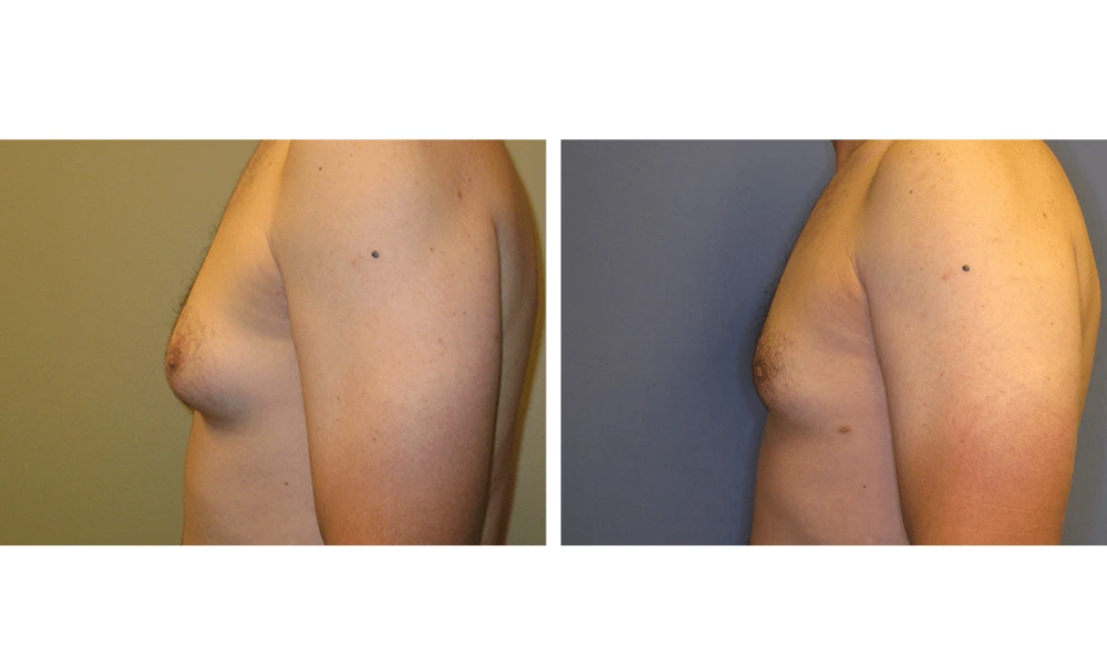 Gynecomastia - Case 1 (4)